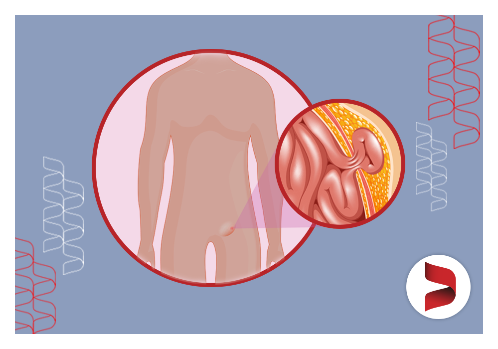 O que é uma hérnia inguinal?