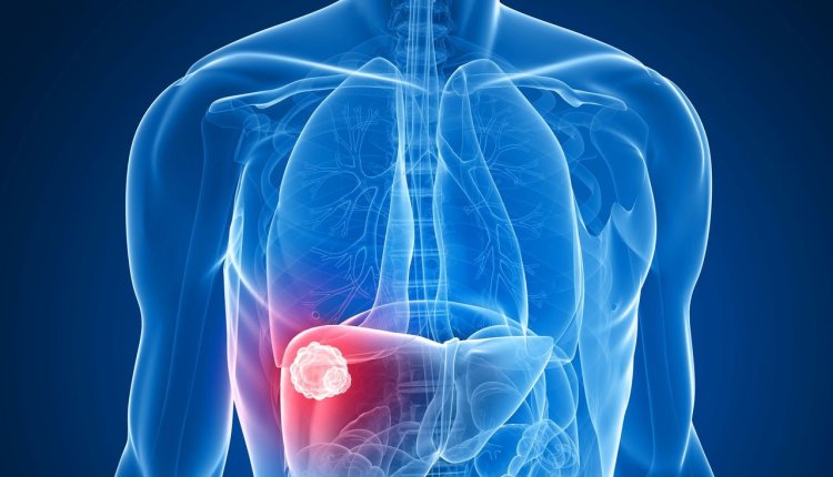 Carcinoma hepatocelular: saiba mais sobre a forma mais comum do câncer de fígado