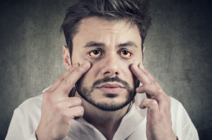 olhos amarelados