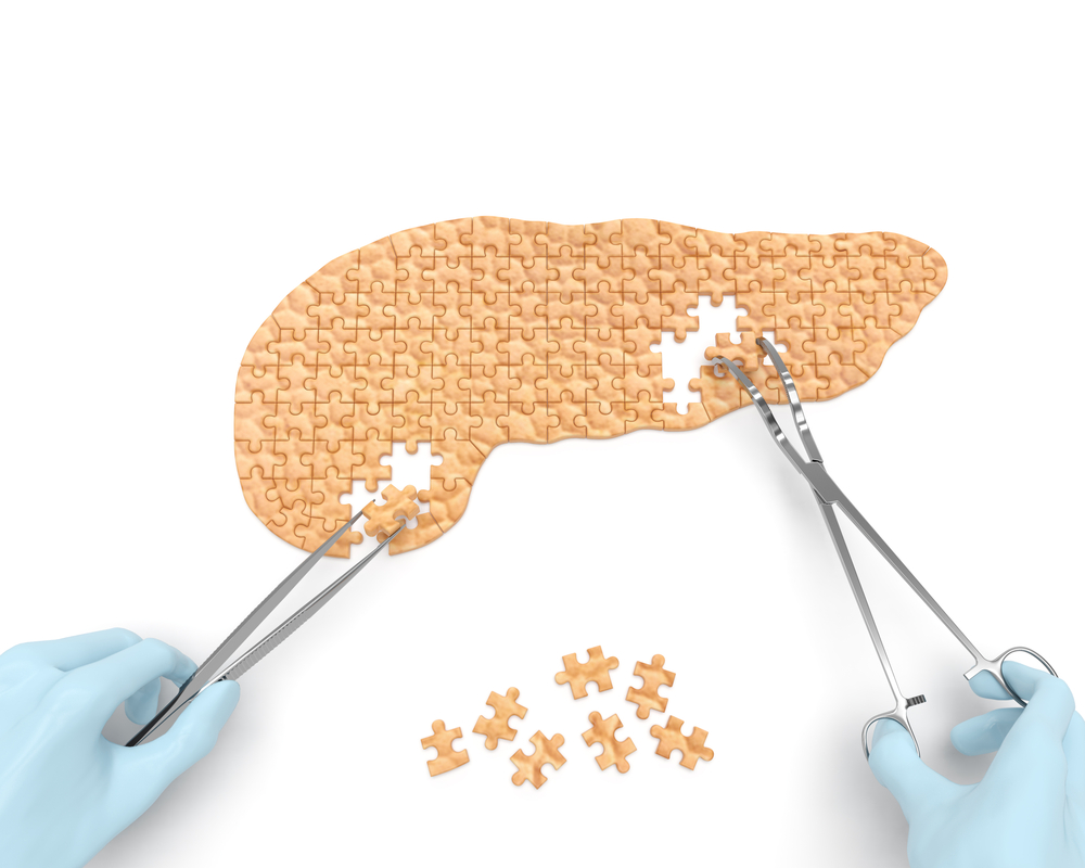 Como é o tratamento cirúrgico dos cistos pancreáticos?