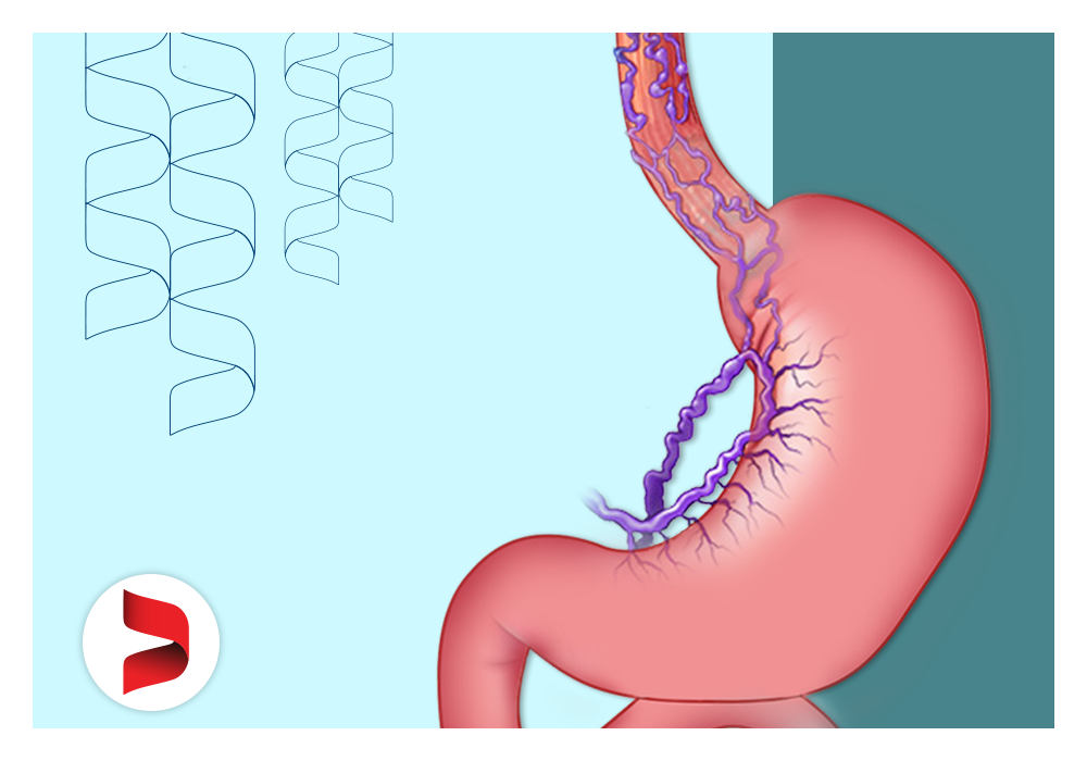 Varizes esofágicas: entenda mais sobre essa alteração